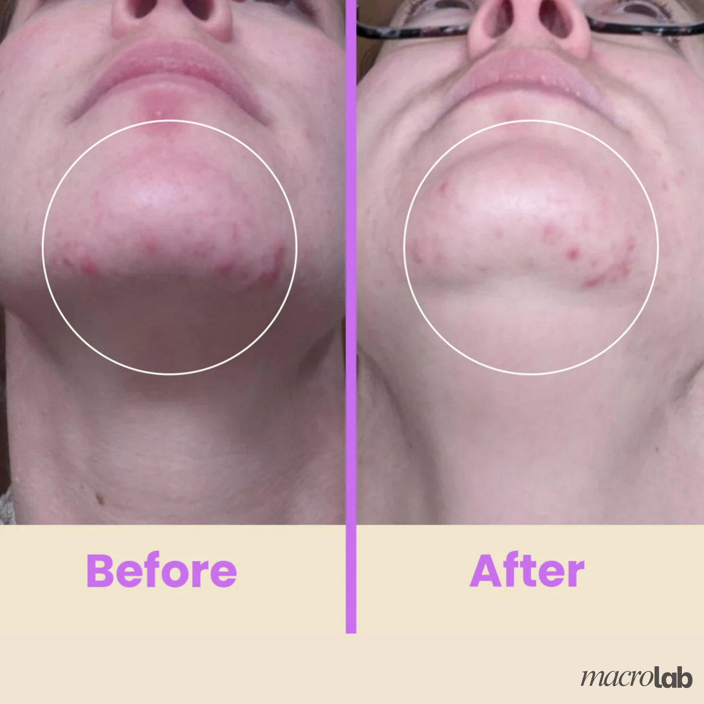 Evina™ Professional High Frequency Wand