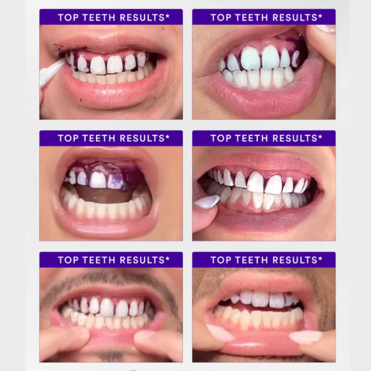 Purple Whitening Strips
