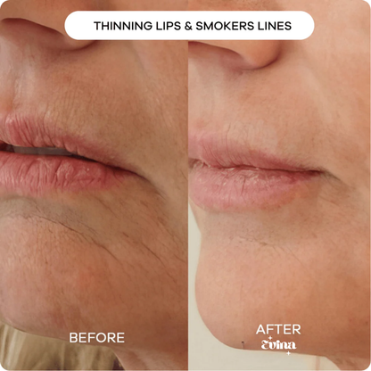 Evina™ Micro Infusion System