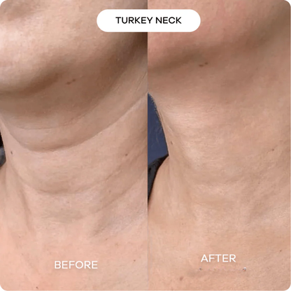 Evina™ Micro Infusion System