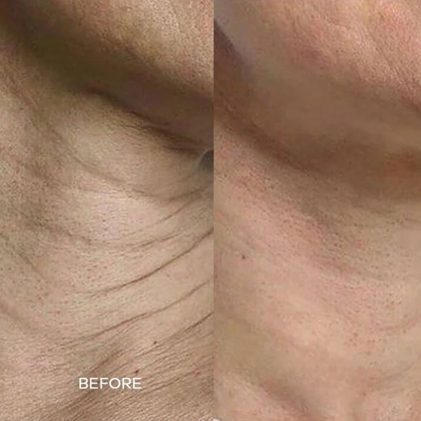 Evina™ Micro Infusion System